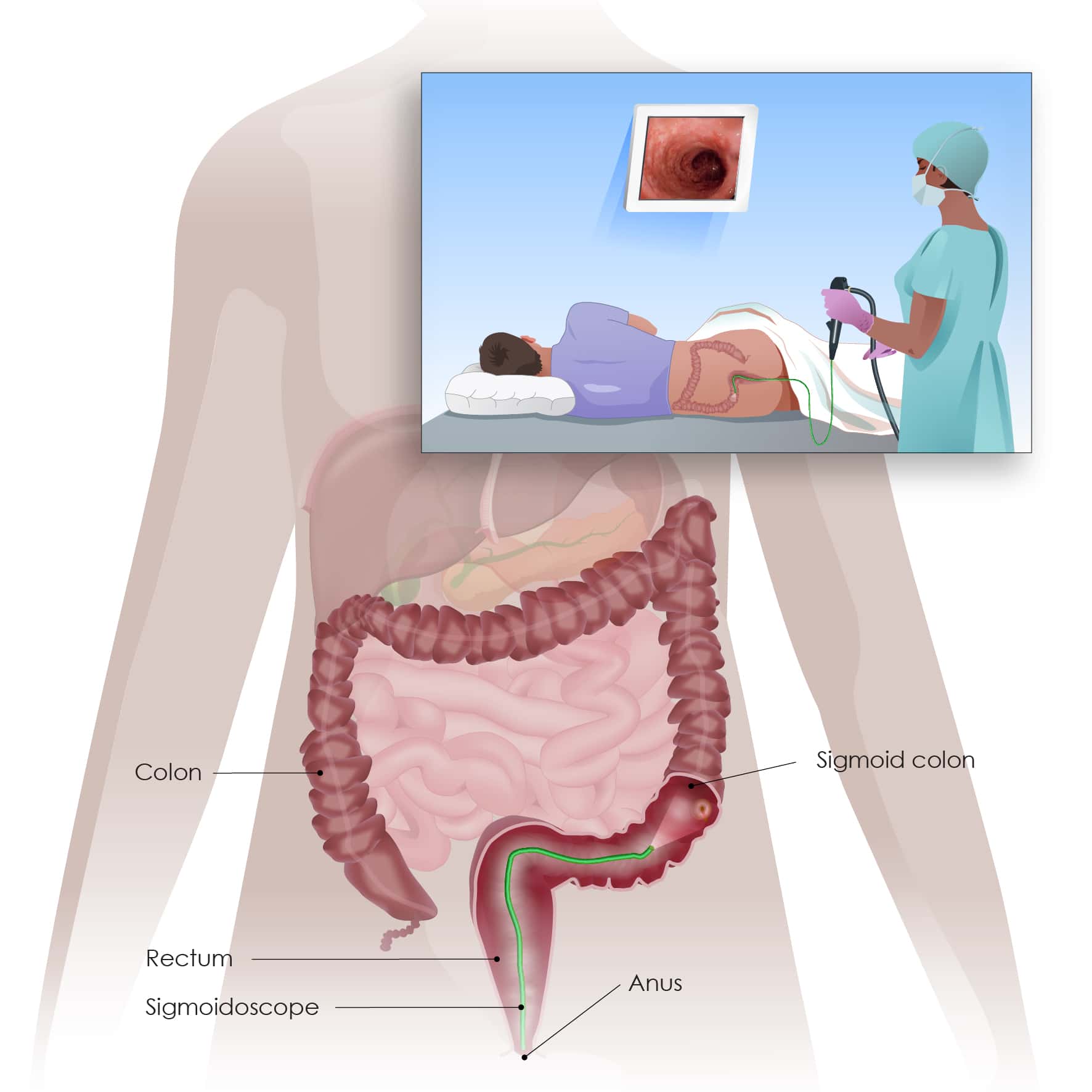 Sigmoidoscopy