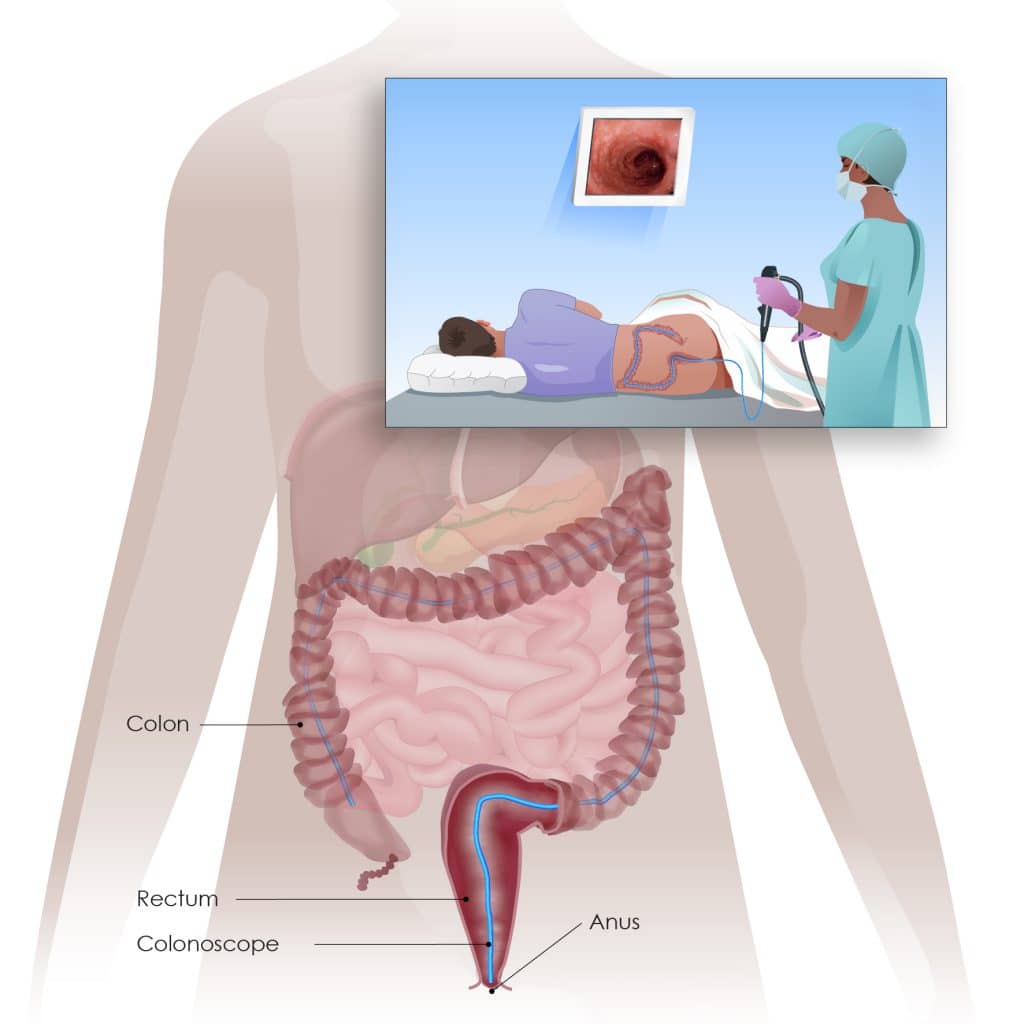 Colorectal Cancer - Screening and testing - Digestive Cancers Europe