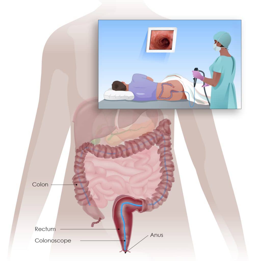 Colorectal Cancer Screening And Testing Digestive Cancers Europe 9806