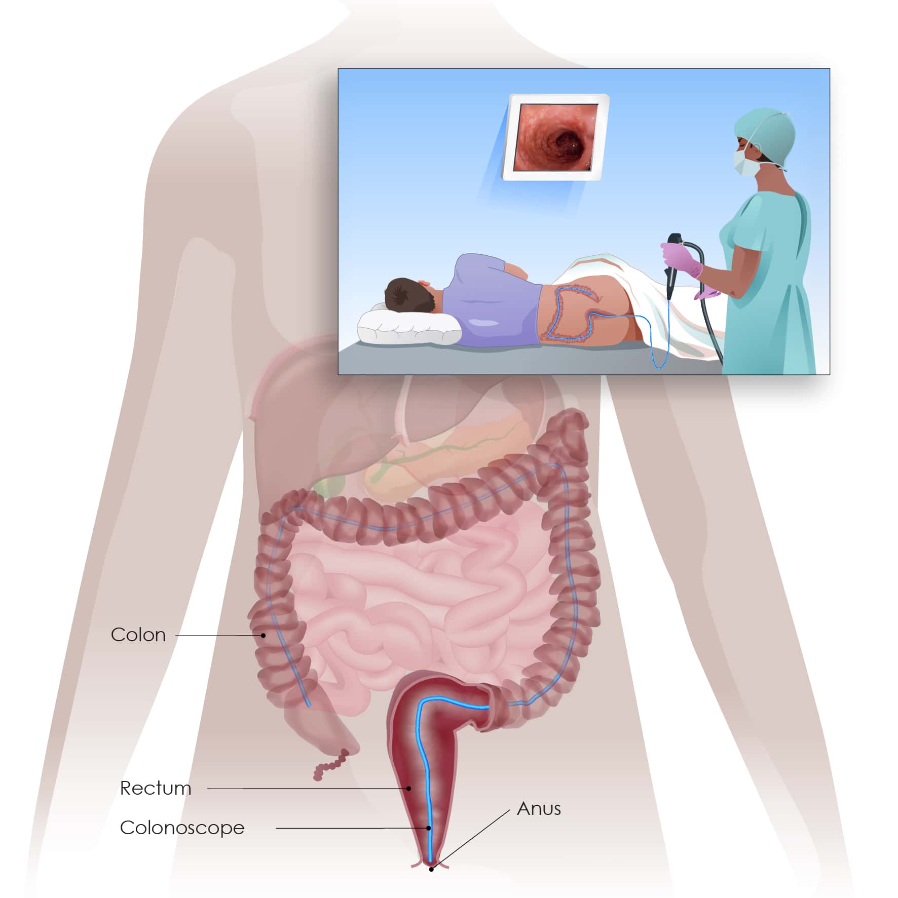 colonoscopy procedure