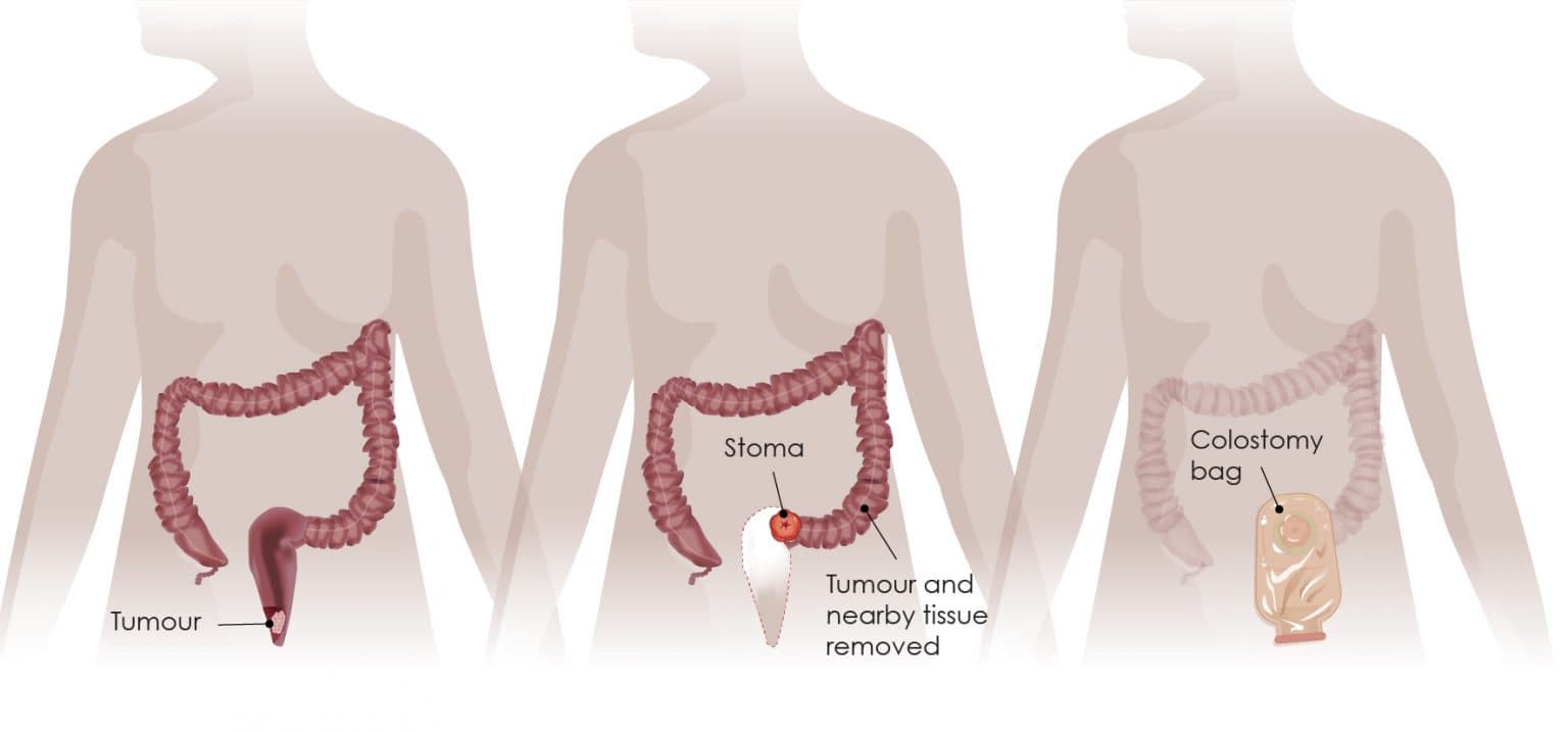 treatments-surgery-digestive-cancers-europe