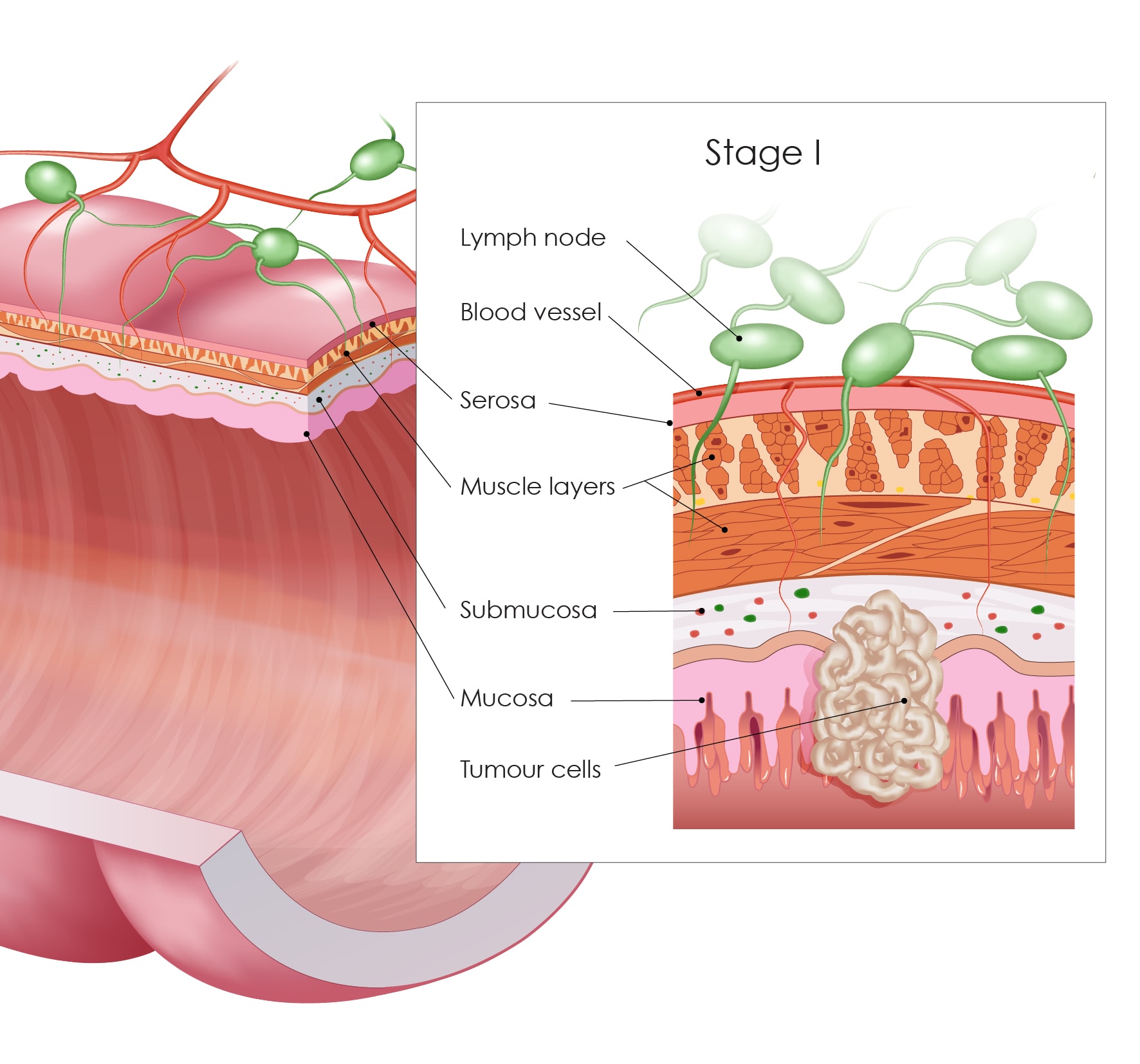 Colon cancer stages