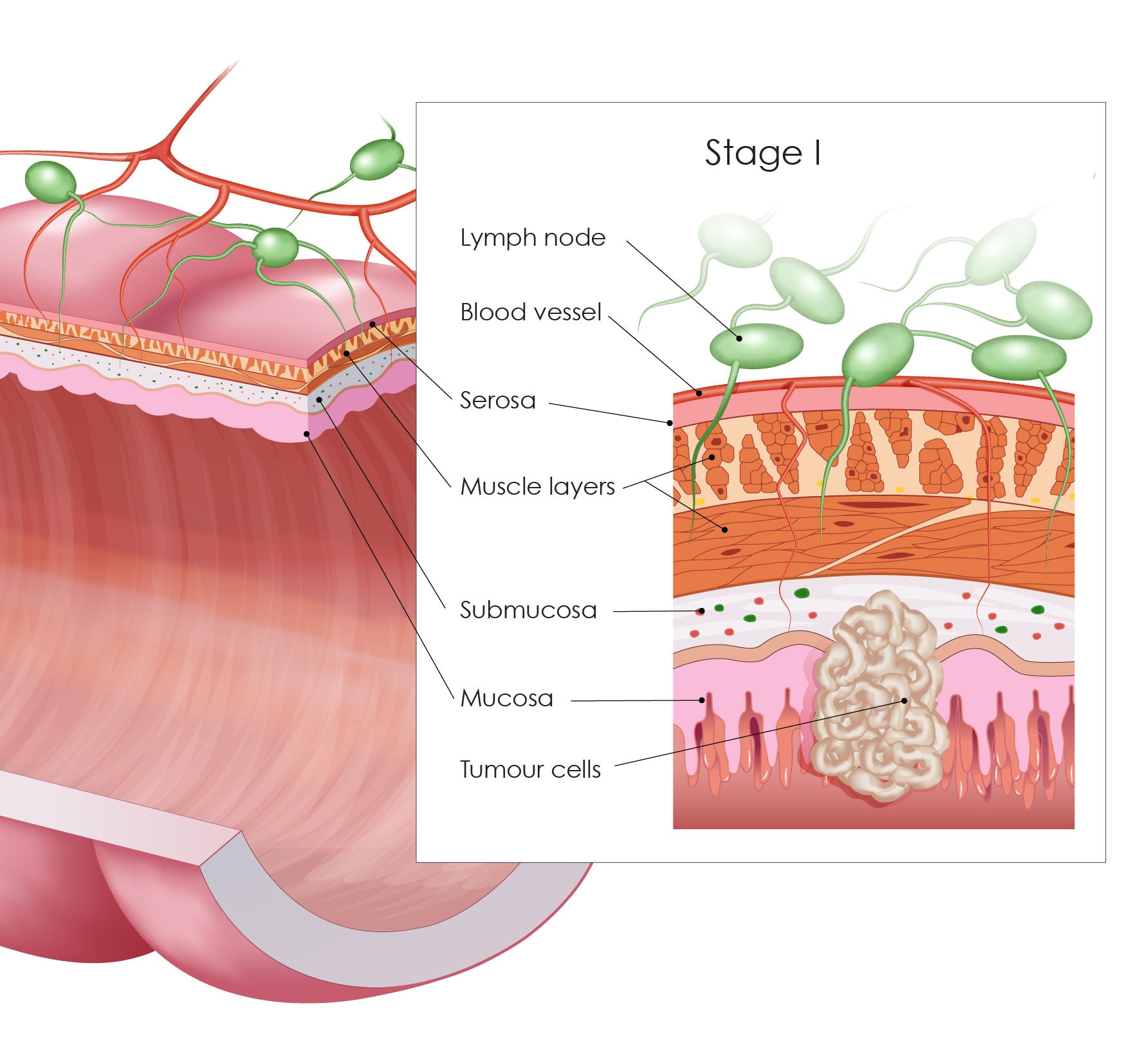 colorectal-cancer-stages